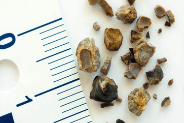 Kidney stones What Is It It’s Causes, Symptoms & Treatment