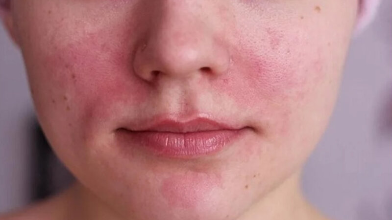 चेहरा लाल होना (रोजेशिया) का घरेलू इलाज