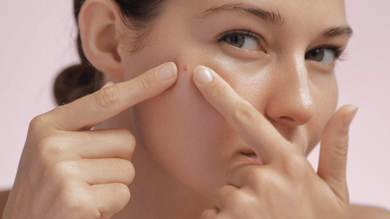 Ayurvedic Treatment For Pimple: Causes, Herbs, Home Remedies